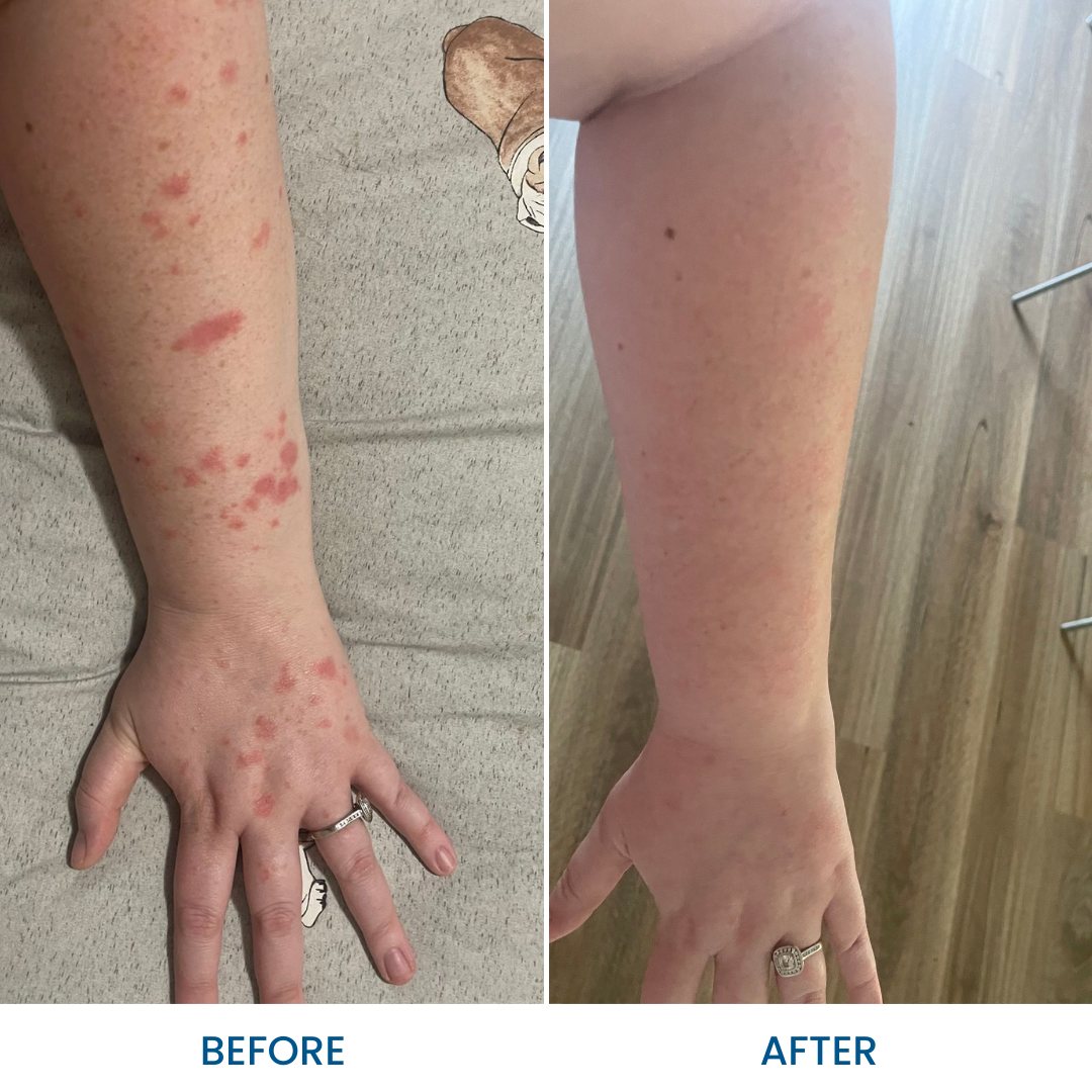 Psoriasis Cream