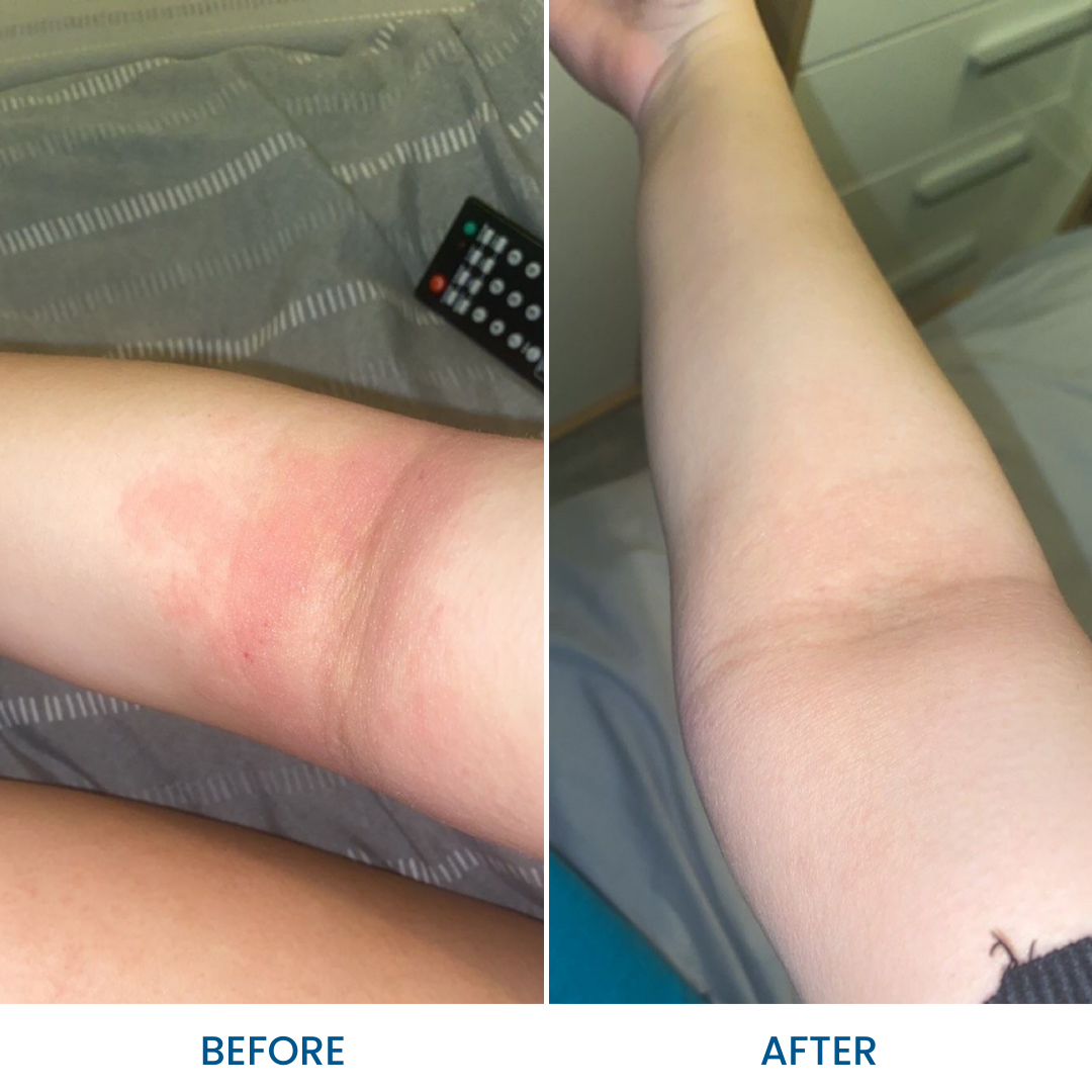 C+ Eczema & Dermatitis Cream