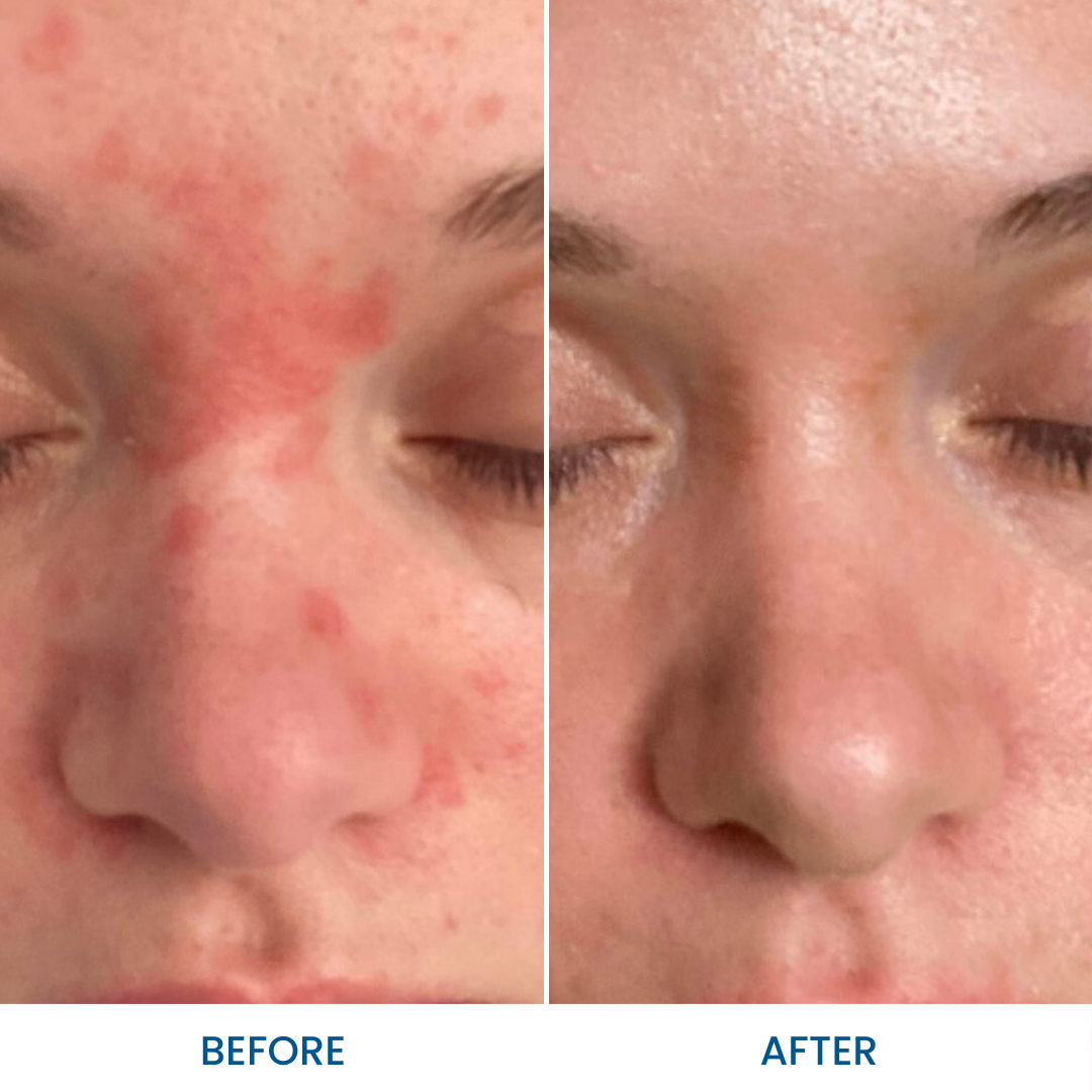 Natural Rosacea Cream